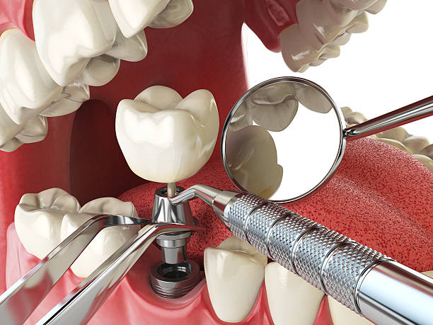 Best Emergency Dentist for Lost Fillings or Crowns in Paris, MO